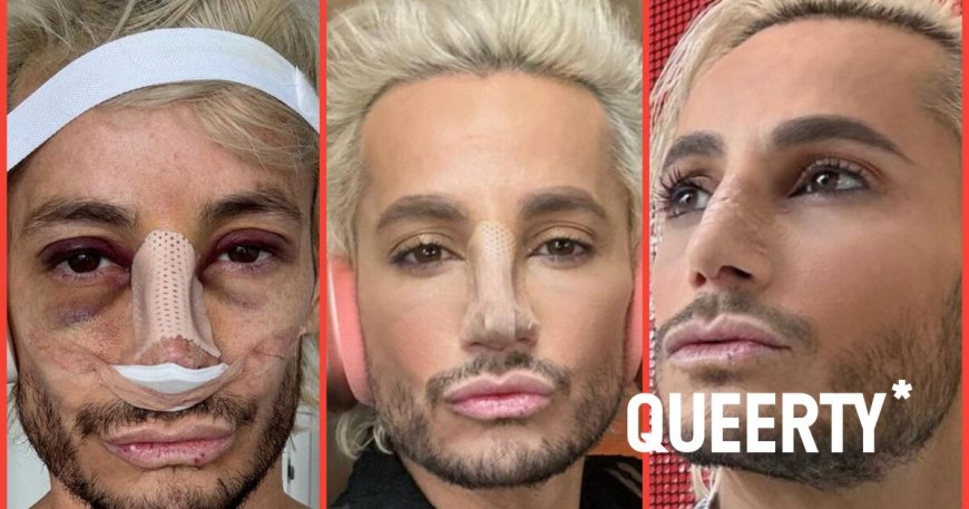 Frankie Grande wants to normalize rhinoplasty by bringing his followers along on his nose job journey